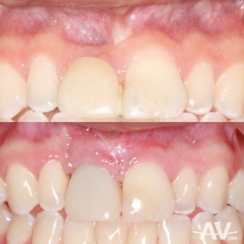 The upper front tooth space with a narrow ridge before treatment, and the finished implant crown in place matching the neighboring teeth