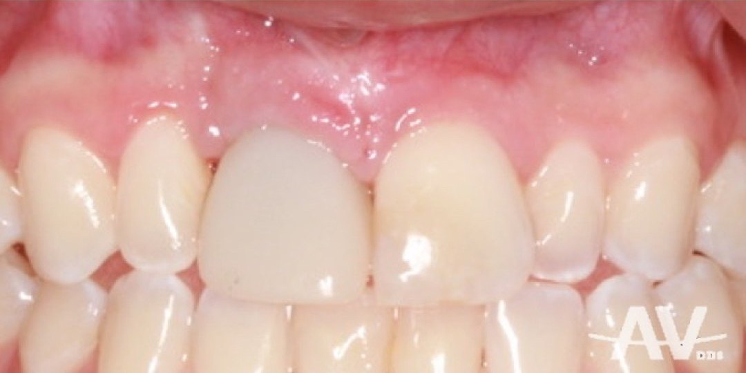 A finished implant crown replacing an upper front tooth, matching the neighboring teeth