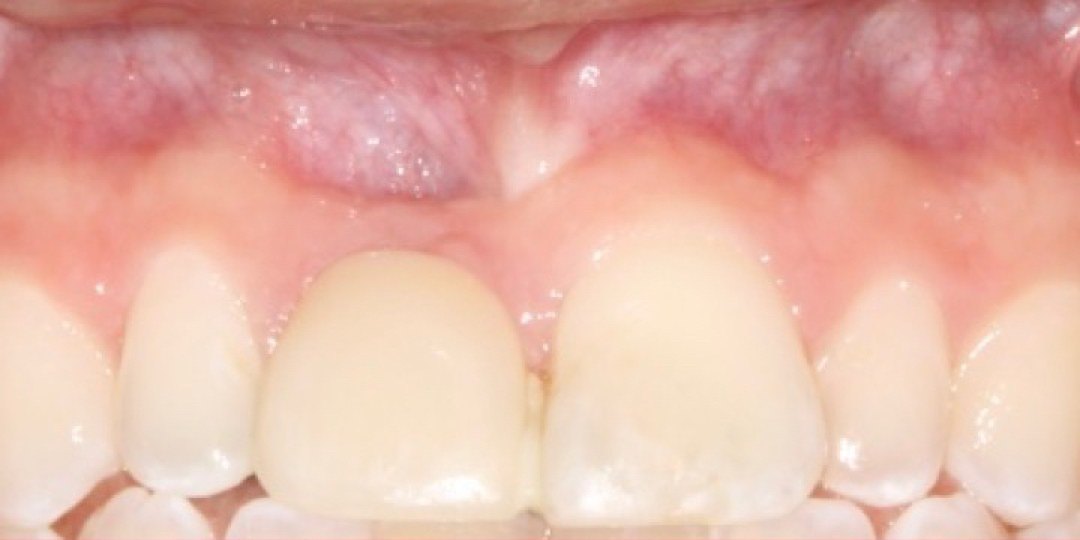 Before: The upper front tooth space with a narrow ridge before treatment, and the finished implant crown in place matching the neighboring teeth