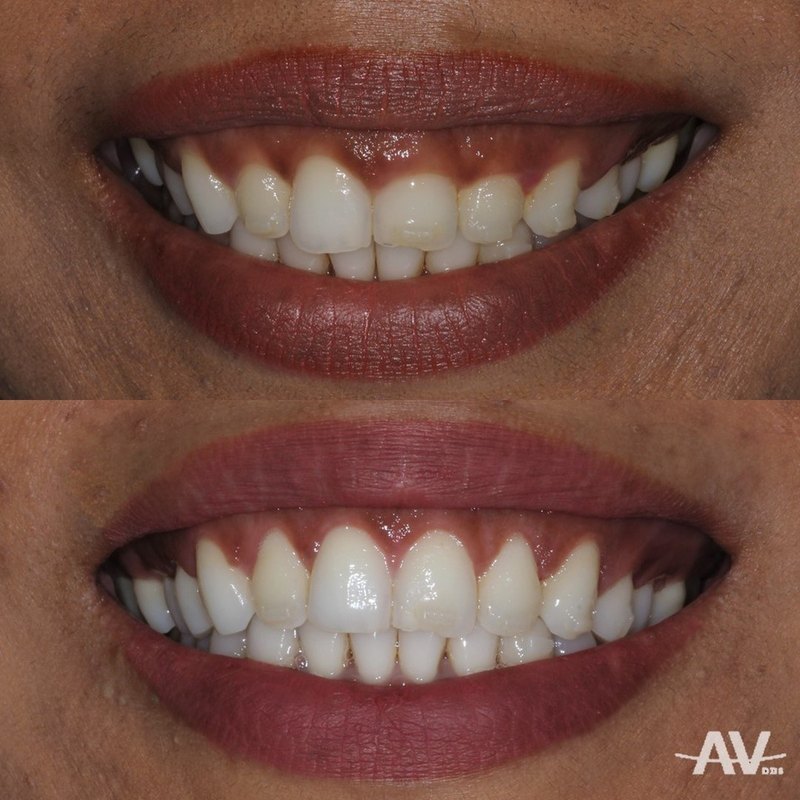 A smile showing a wide band of gum above short-looking upper teeth, and the same smile after esthetic crown lengthening with a higher, even gumline and full-length teeth