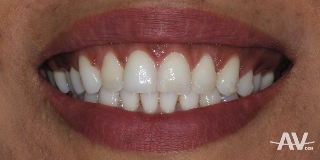 After: A smile showing a wide band of gum above short-looking upper teeth, and the same smile after esthetic crown lengthening with a higher, even gumline and full-length teeth
