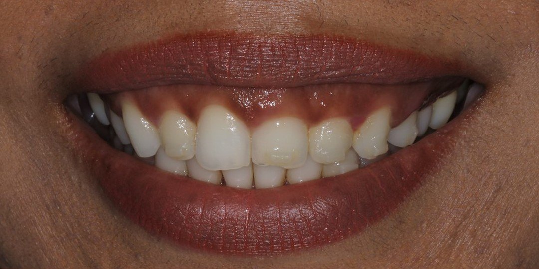 Before: A smile showing a wide band of gum above short-looking upper teeth, and the same smile after esthetic crown lengthening with a higher, even gumline and full-length teeth
