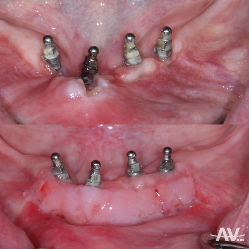 Lower implant abutments surrounded by thin, loose tissue with a sore, and the same implants two weeks after a free gingival graft with a thick band of firm gum
