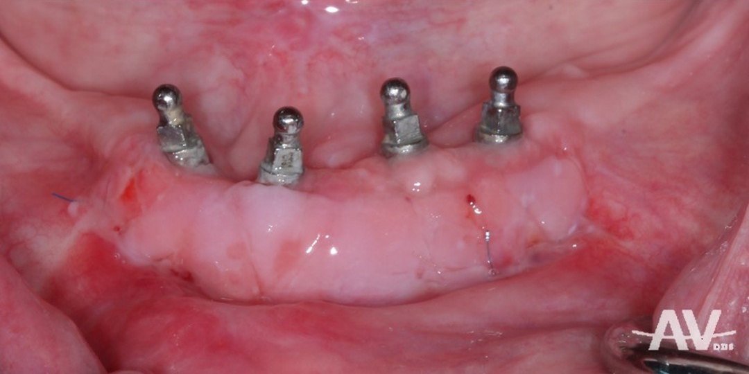 After: Lower implant abutments surrounded by thin, loose tissue with a sore, and the same implants two weeks after a free gingival graft with a thick band of firm gum