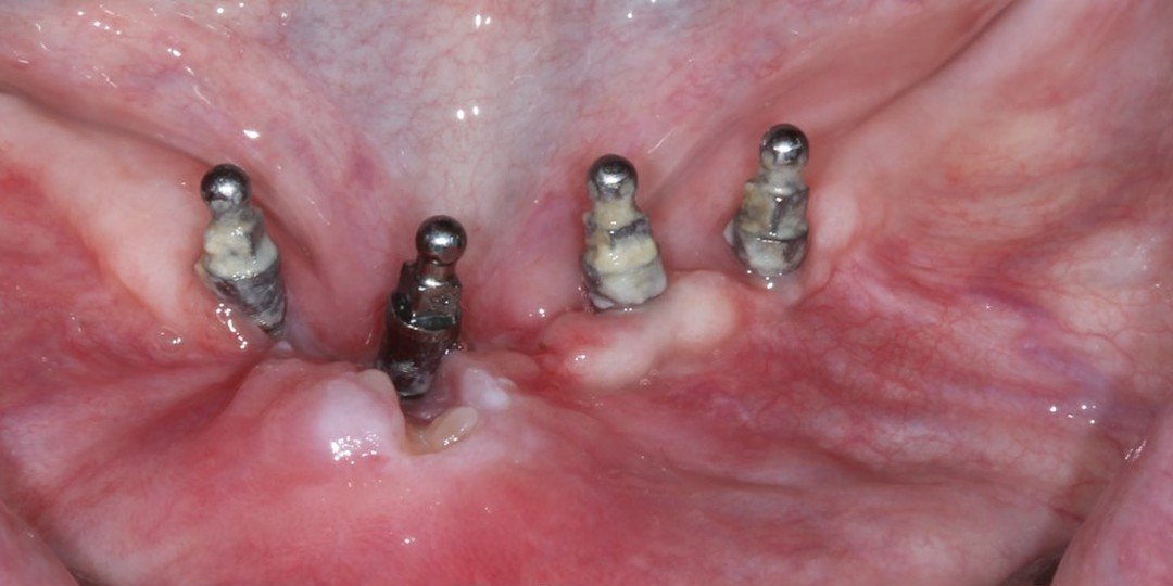 Before: Lower implant abutments surrounded by thin, loose tissue with a sore, and the same implants two weeks after a free gingival graft with a thick band of firm gum