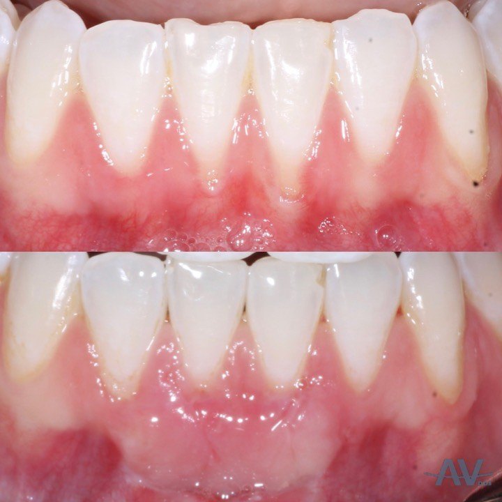 Lower front teeth with thin, reddish gum and no attached tissue below them, and the same teeth after a free gingival graft with a wide band of pale, firm gum