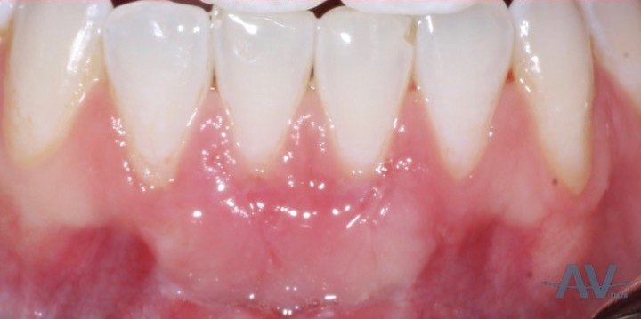 After: Lower front teeth with thin, reddish gum and no attached tissue below them, and the same teeth after a free gingival graft with a wide band of pale, firm gum