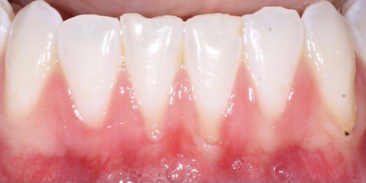 Before: Lower front teeth with thin, reddish gum and no attached tissue below them, and the same teeth after a free gingival graft with a wide band of pale, firm gum