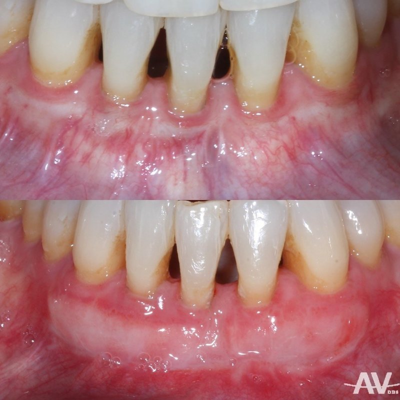 Lower front teeth with thin gum and recession, and the same teeth one month after a free gingival graft with a wide band of thick, firm gum