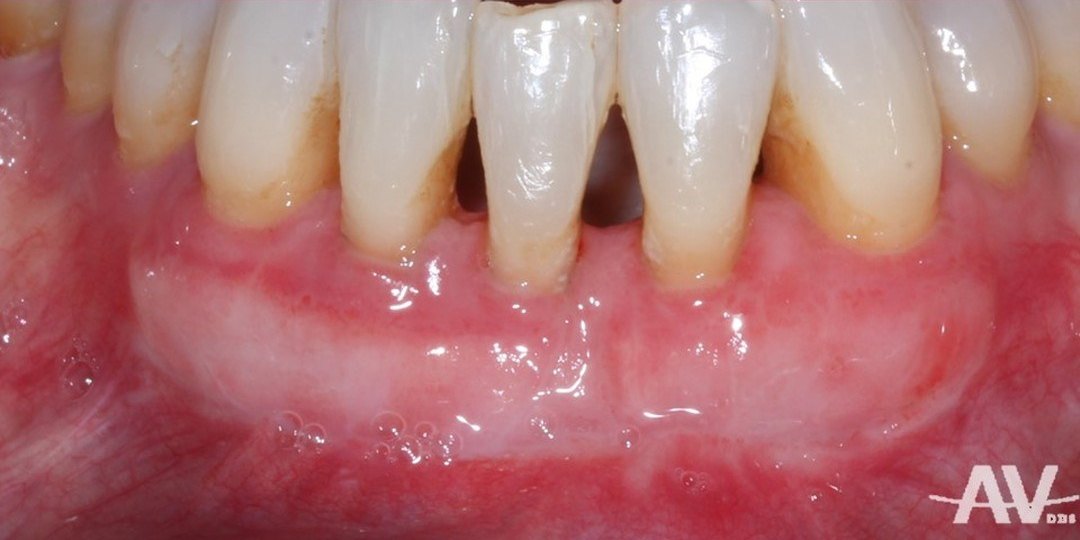 After: Lower front teeth with thin gum and recession, and the same teeth one month after a free gingival graft with a wide band of thick, firm gum