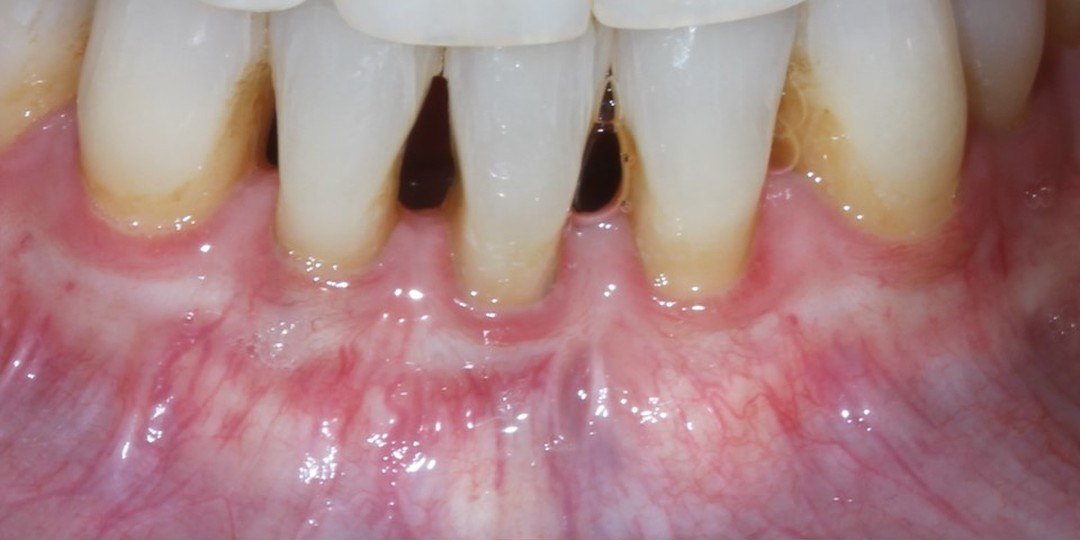 Before: Lower front teeth with thin gum and recession, and the same teeth one month after a free gingival graft with a wide band of thick, firm gum