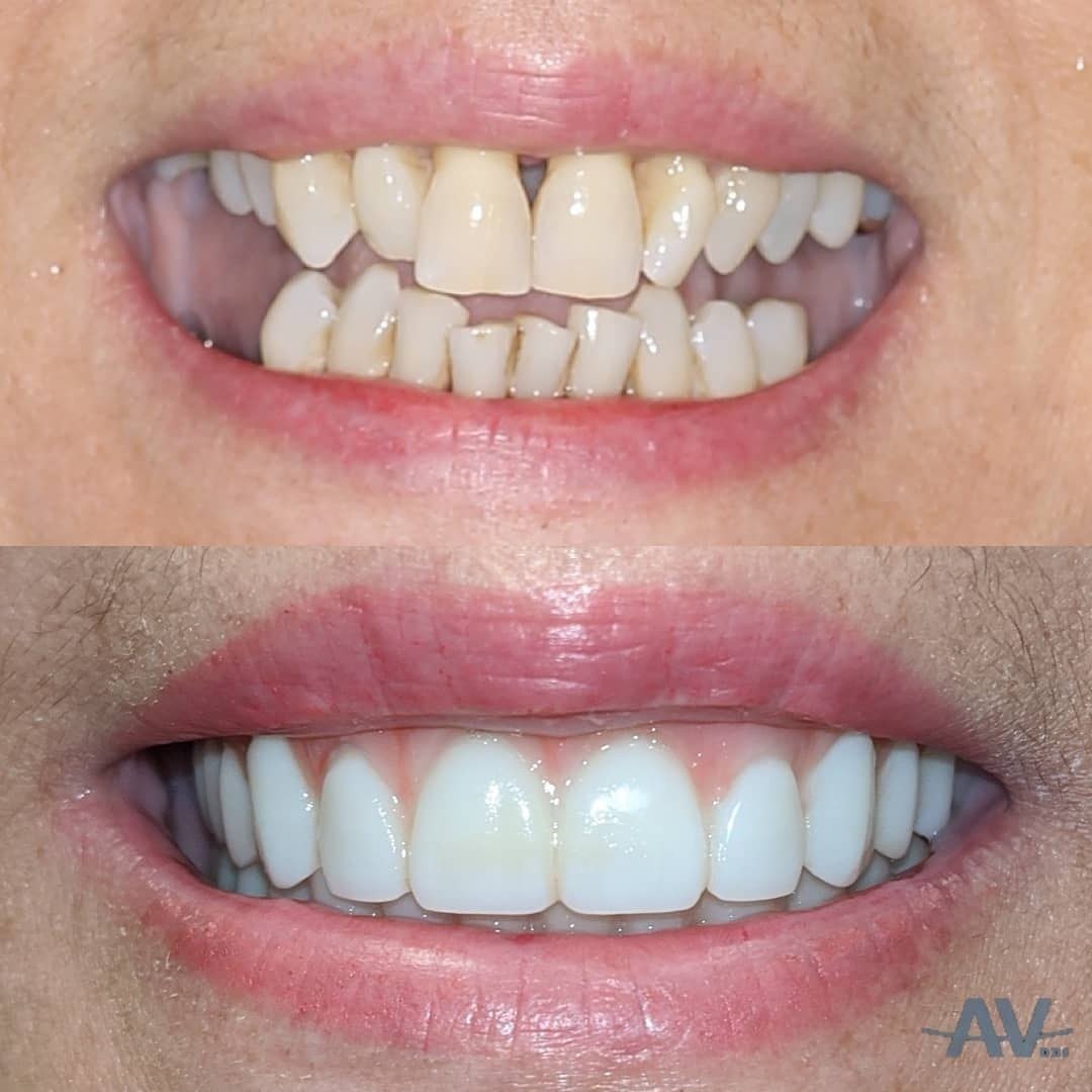 A smile with worn, uneven failing teeth, and the same smile after full-arch implant reconstruction with a complete set of fixed teeth