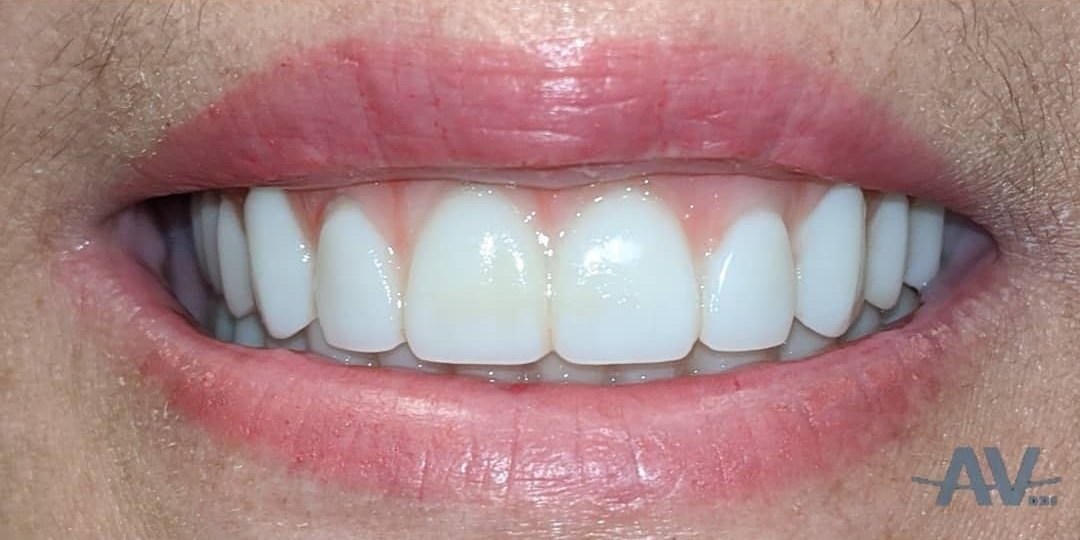 After: A smile with worn, uneven failing teeth, and the same smile after full-arch implant reconstruction with a complete set of fixed teeth