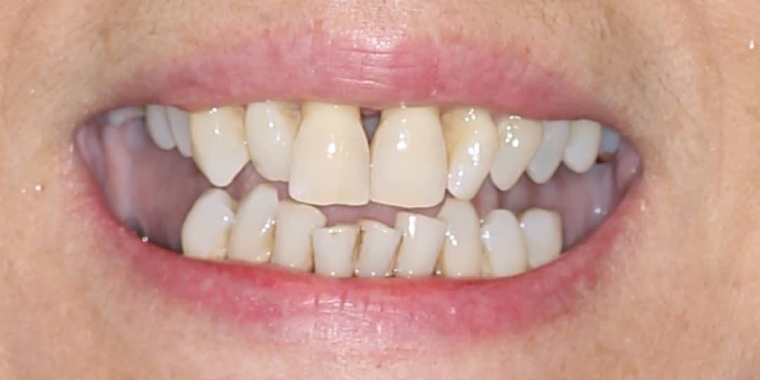 Before: A smile with worn, uneven failing teeth, and the same smile after full-arch implant reconstruction with a complete set of fixed teeth