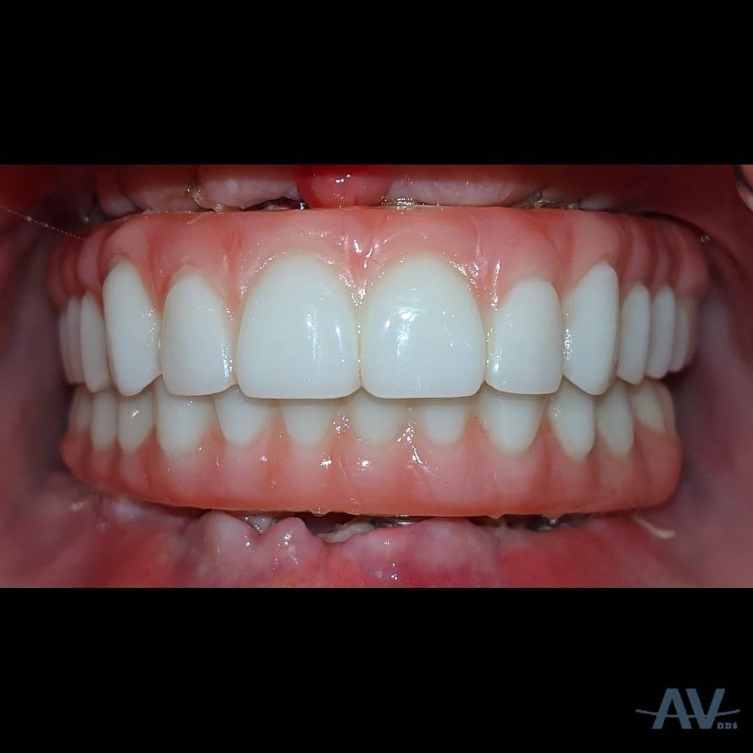 The finished full-arch fixed bridges in both jaws, seen with the lips retracted