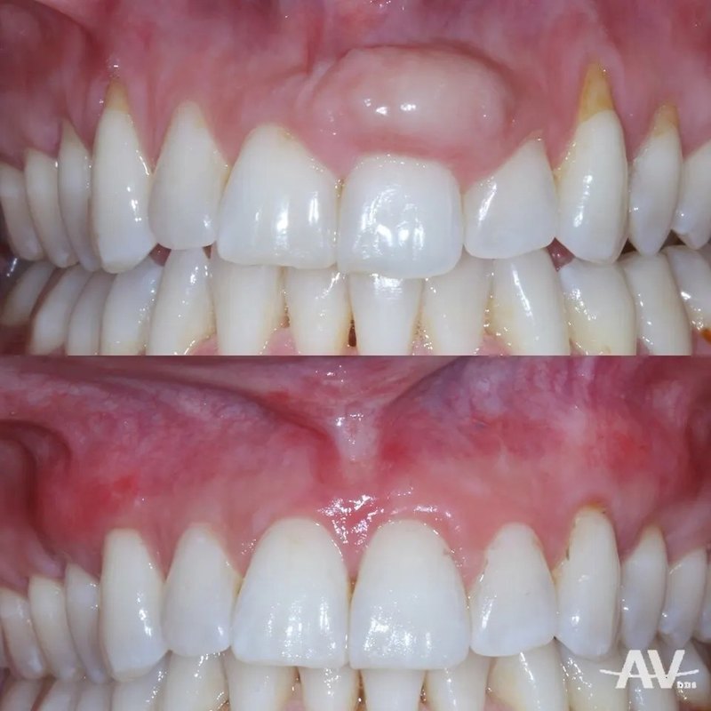 A smooth, firm swelling of the gum above an upper front tooth before treatment, and the same area after removal and grafting with an even gumline