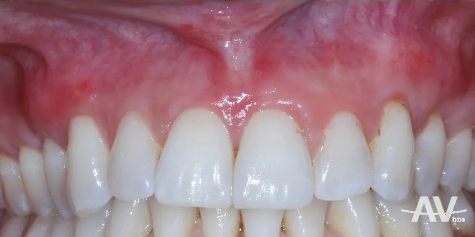 After: A smooth, firm swelling of the gum above an upper front tooth before treatment, and the same area after removal and grafting with an even gumline