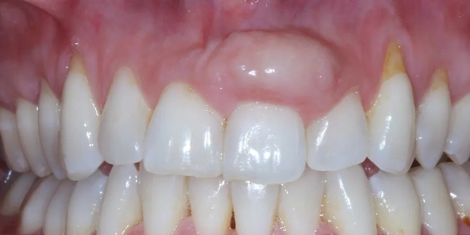 Before: A smooth, firm swelling of the gum above an upper front tooth before treatment, and the same area after removal and grafting with an even gumline