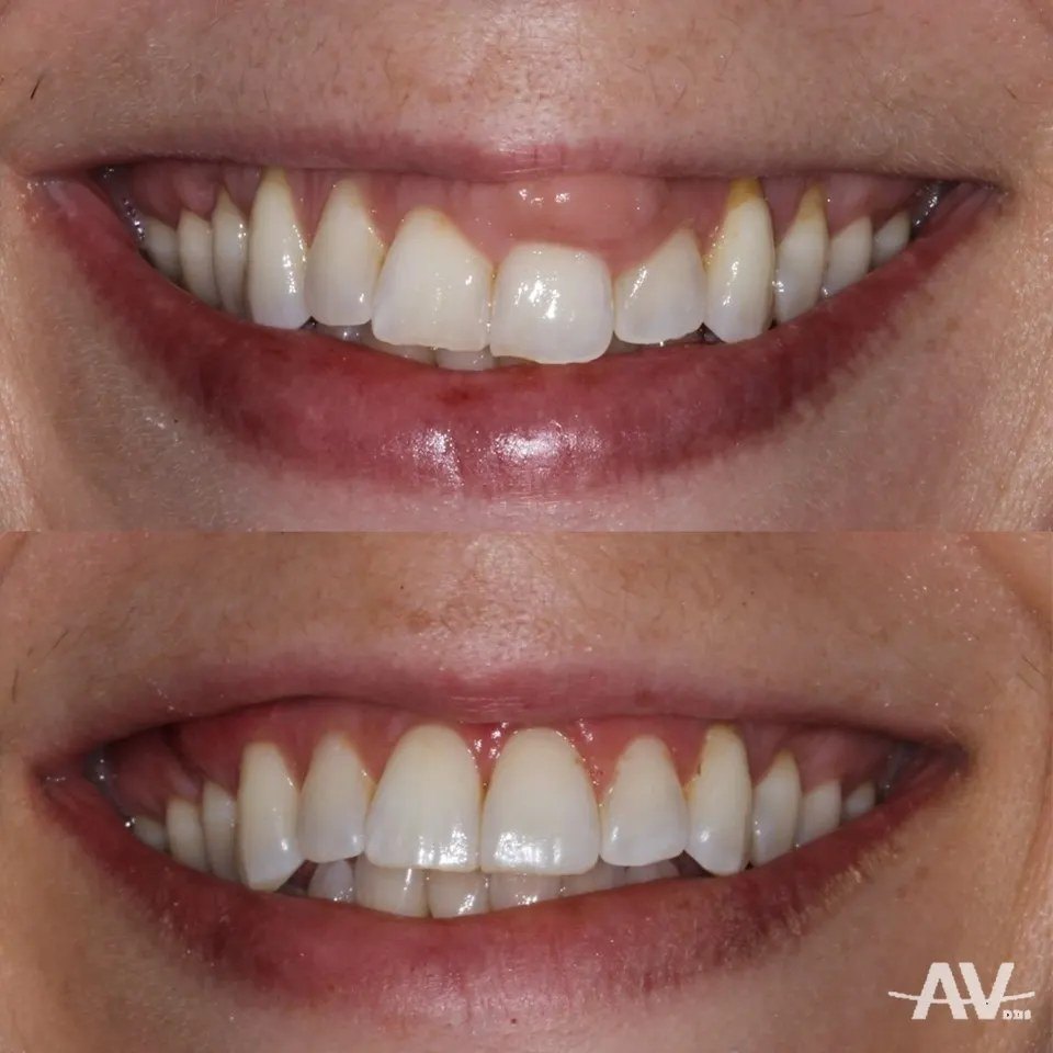 The patient's smile before treatment with the gum swelling visible above a front tooth, and after treatment with a smooth gumline