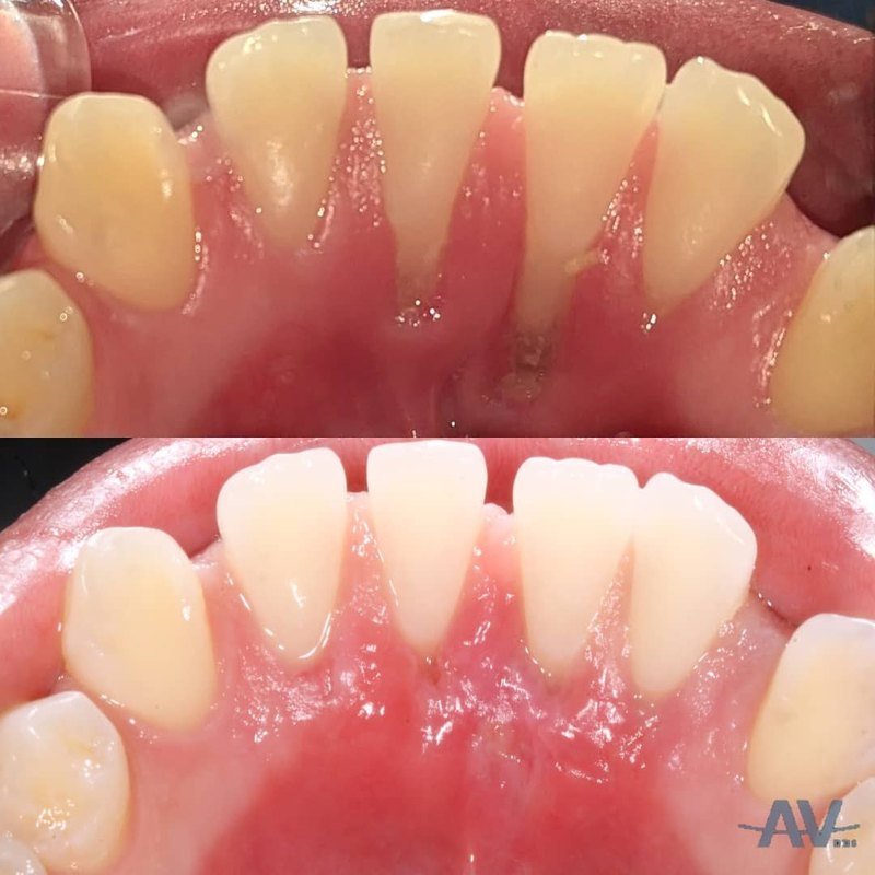 The tongue side of the lower front teeth with gum recession exposing the roots, and the same view two weeks after a tunnel connective tissue graft with thick new tissue covering the roots