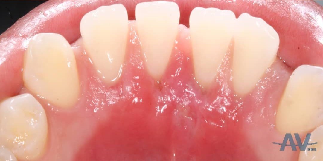 After: The tongue side of the lower front teeth with gum recession exposing the roots, and the same view two weeks after a tunnel connective tissue graft with thick new tissue covering the roots