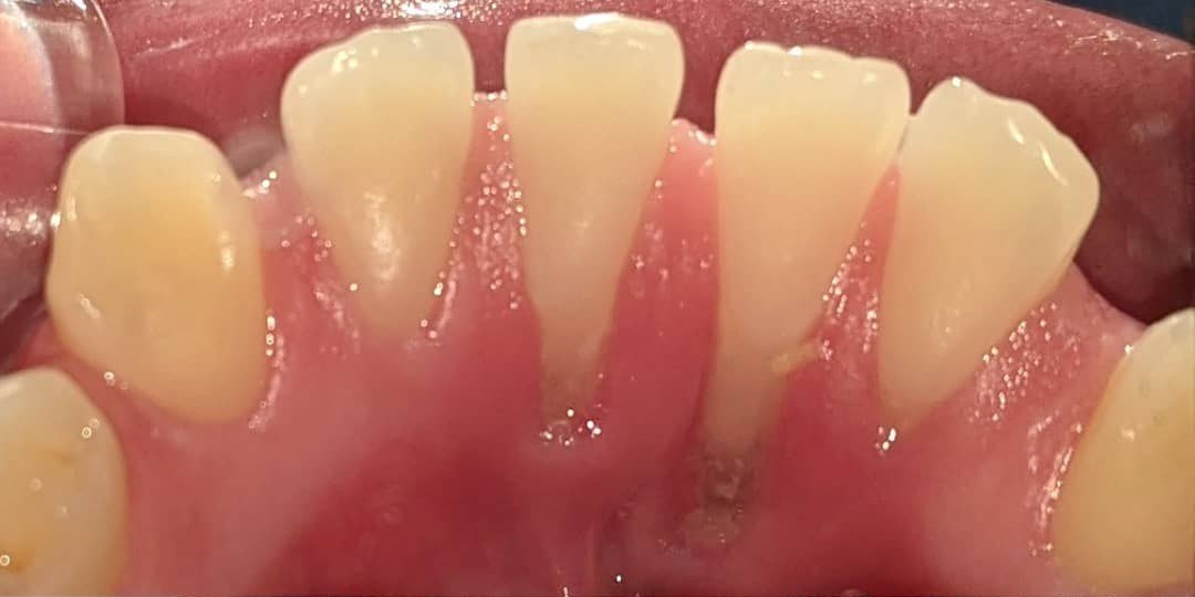 Before: The tongue side of the lower front teeth with gum recession exposing the roots, and the same view two weeks after a tunnel connective tissue graft with thick new tissue covering the roots