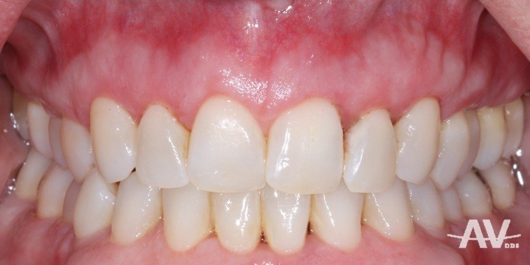 After: Inflamed, swollen gums with visible tartar before treatment, and the same mouth one month after periodontal surgery with pink, firm gums
