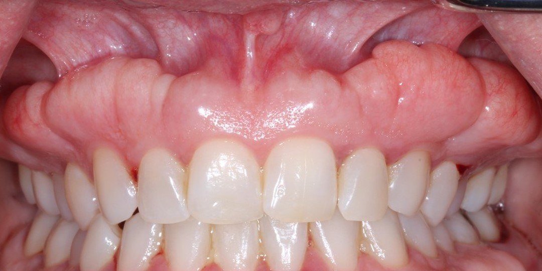 Before: Inflamed, swollen gums with visible tartar before treatment, and the same mouth one month after periodontal surgery with pink, firm gums