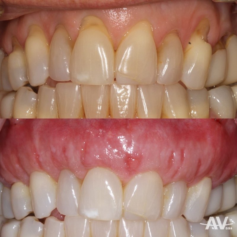 Upper teeth with gum recession exposing several roots, and the same teeth two weeks after a tunnel graft with donor tissue showing the roots covered and the gumline even