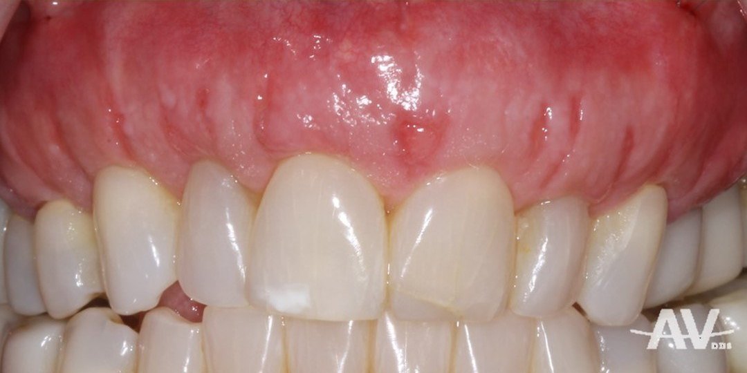 After: Upper teeth with gum recession exposing several roots, and the same teeth two weeks after a tunnel graft with donor tissue showing the roots covered and the gumline even