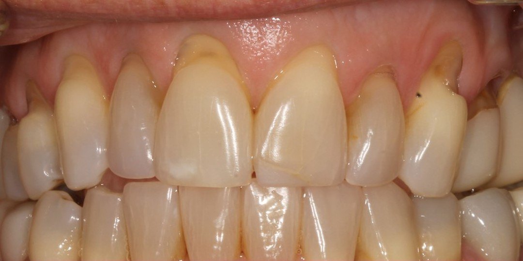Before: Upper teeth with gum recession exposing several roots, and the same teeth two weeks after a tunnel graft with donor tissue showing the roots covered and the gumline even