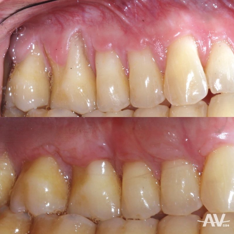 Upper teeth with a deep angular recession defect and clefts in thin gum, and the same teeth one year after a tunnel connective tissue graft with the roots covered and the tissue thick and stable