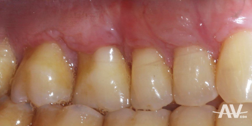 After: Upper teeth with a deep angular recession defect and clefts in thin gum, and the same teeth one year after a tunnel connective tissue graft with the roots covered and the tissue thick and stable