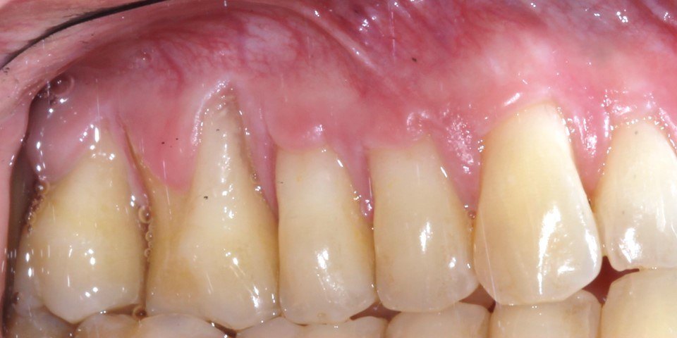 Before: Upper teeth with a deep angular recession defect and clefts in thin gum, and the same teeth one year after a tunnel connective tissue graft with the roots covered and the tissue thick and stable