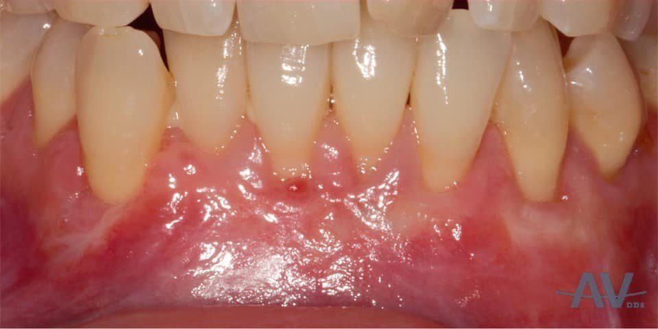 After: Lower front teeth with severe gum recession exposing the roots, and the same teeth one month after a tunnel connective tissue graft with the roots covered and the gum thickened