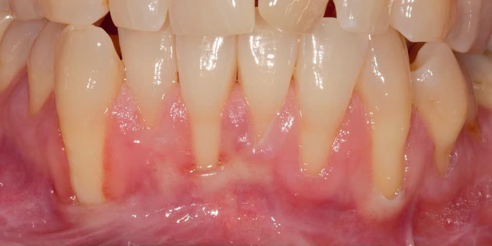 Before: Lower front teeth with severe gum recession exposing the roots, and the same teeth one month after a tunnel connective tissue graft with the roots covered and the gum thickened
