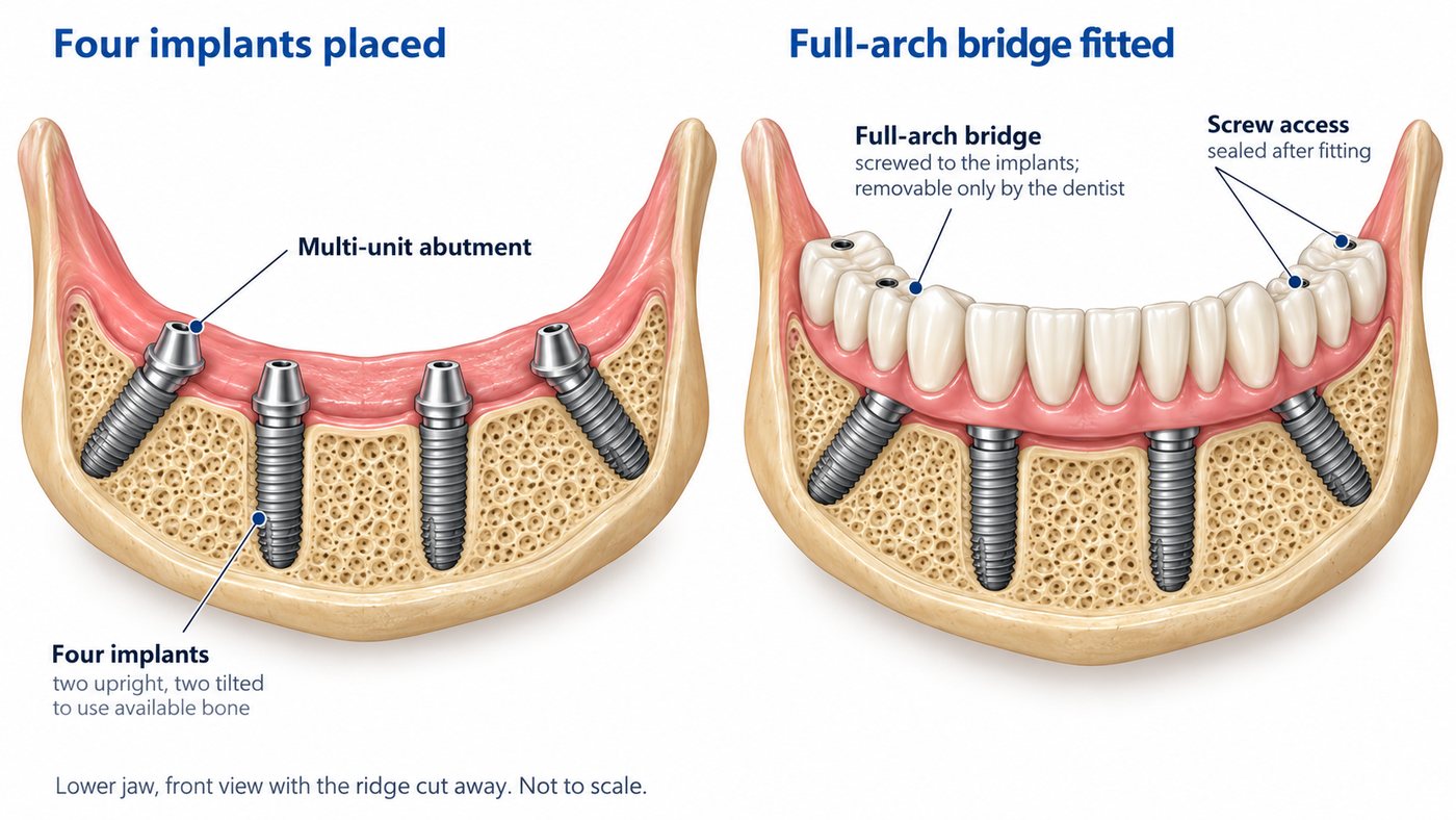 A lower jaw with four implants placed, two upright and two tilted, then the same jaw with a full-arch fixed bridge of twelve teeth screwed onto them