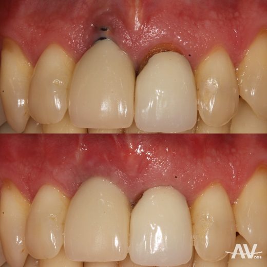 Before and after a connective tissue graft over a dental implant on an upper front tooth