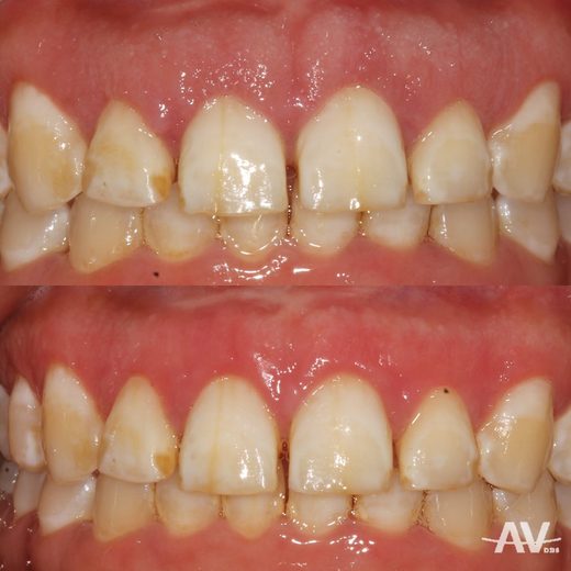 Before and after esthetic crown lengthening on the upper front teeth